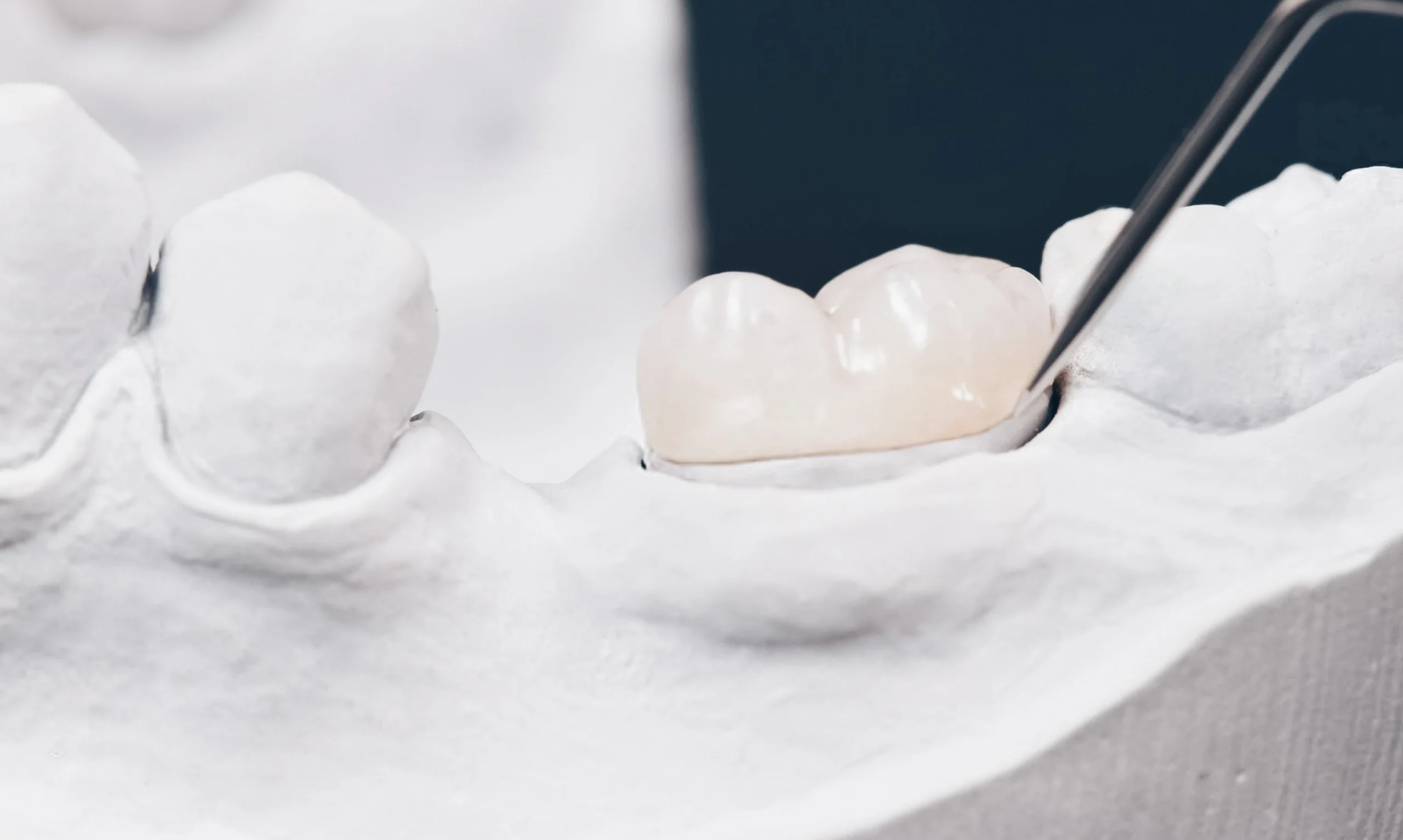 Le composite stratifié est un couche est durcie à l'aide d'une lumière spéciale au cabinet dentaire du Dr Bajanescu