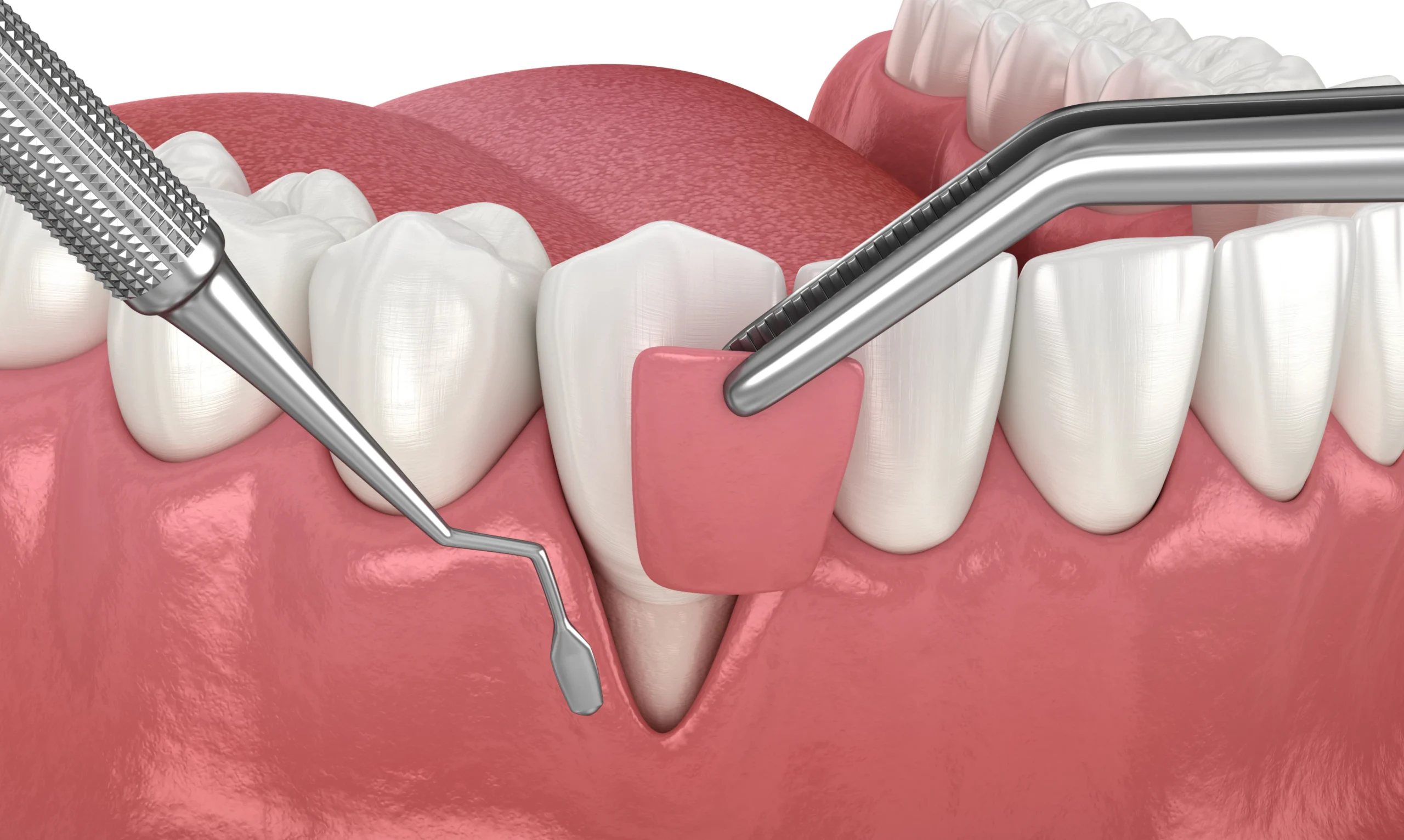 Les greffes osseuses au cabinet dentaire du Dr Bajanescu à Salins-les-Bains