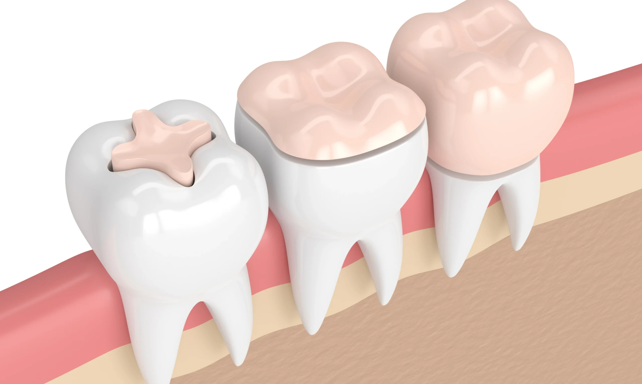 Les inlay - onlay remplissent une cavité à l'intérieur des cuspides de la dent
