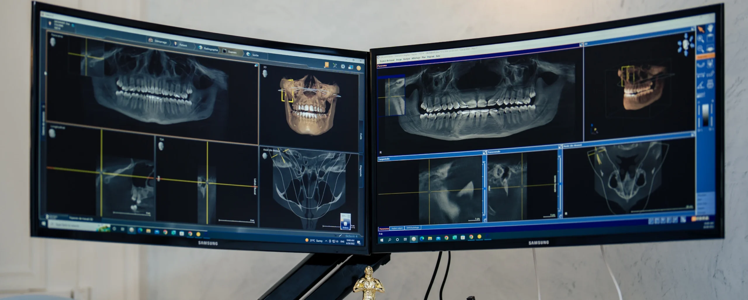 Planification implantaire, implants, chirurgien-dentiste Dr Bajanescu à Salins-les-Bains 39110