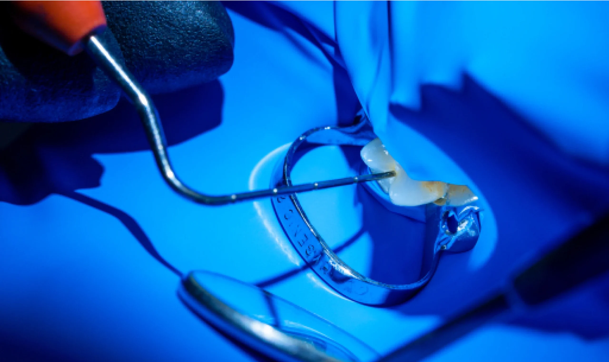 Restauration adhésive en céramique, Bajanescu 39110